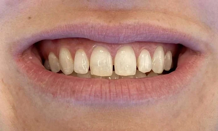 Before: small gaps between the upper front teeth.